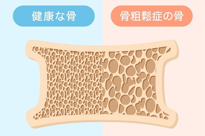 骨密度の比較イメージ・骨粗鬆症の検査と予防